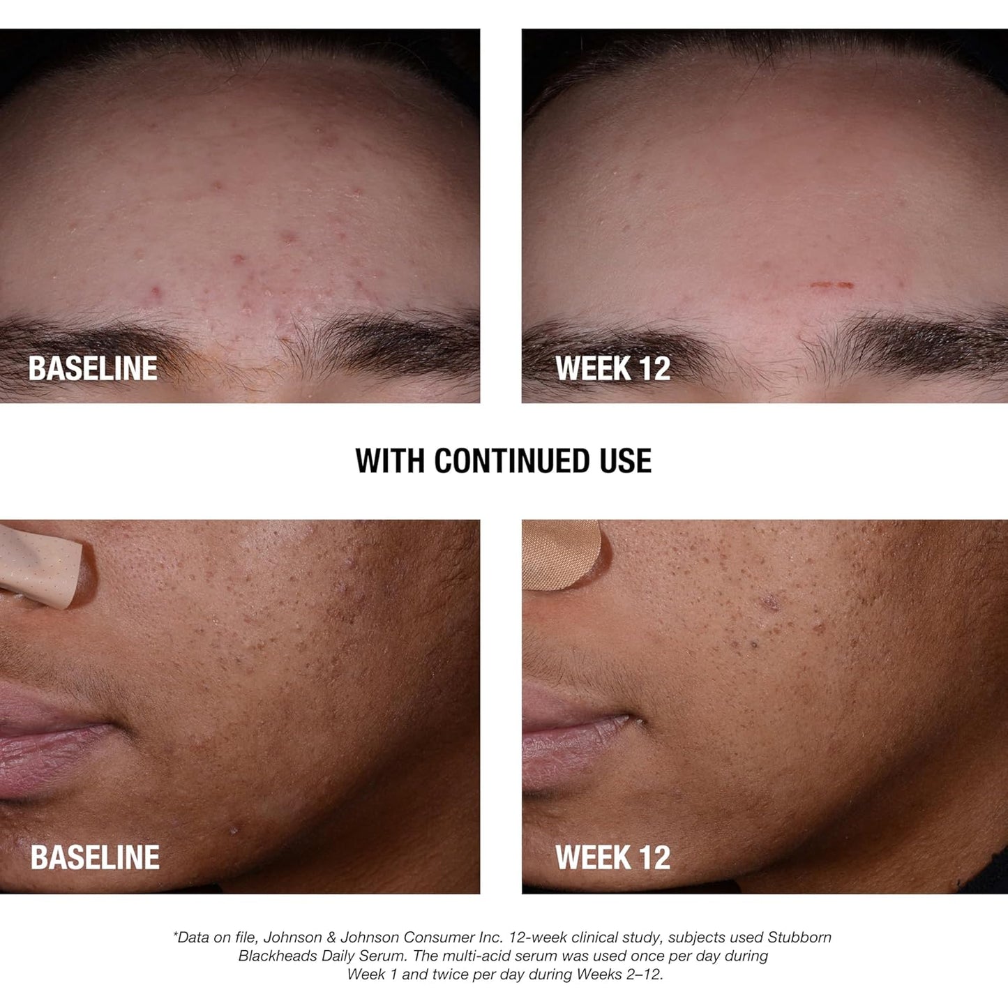 Neutrogena Acne Facial Serum - Daily Treatment with Salicylic & Glycolic Acids | 1 fl. oz for Clear Skin