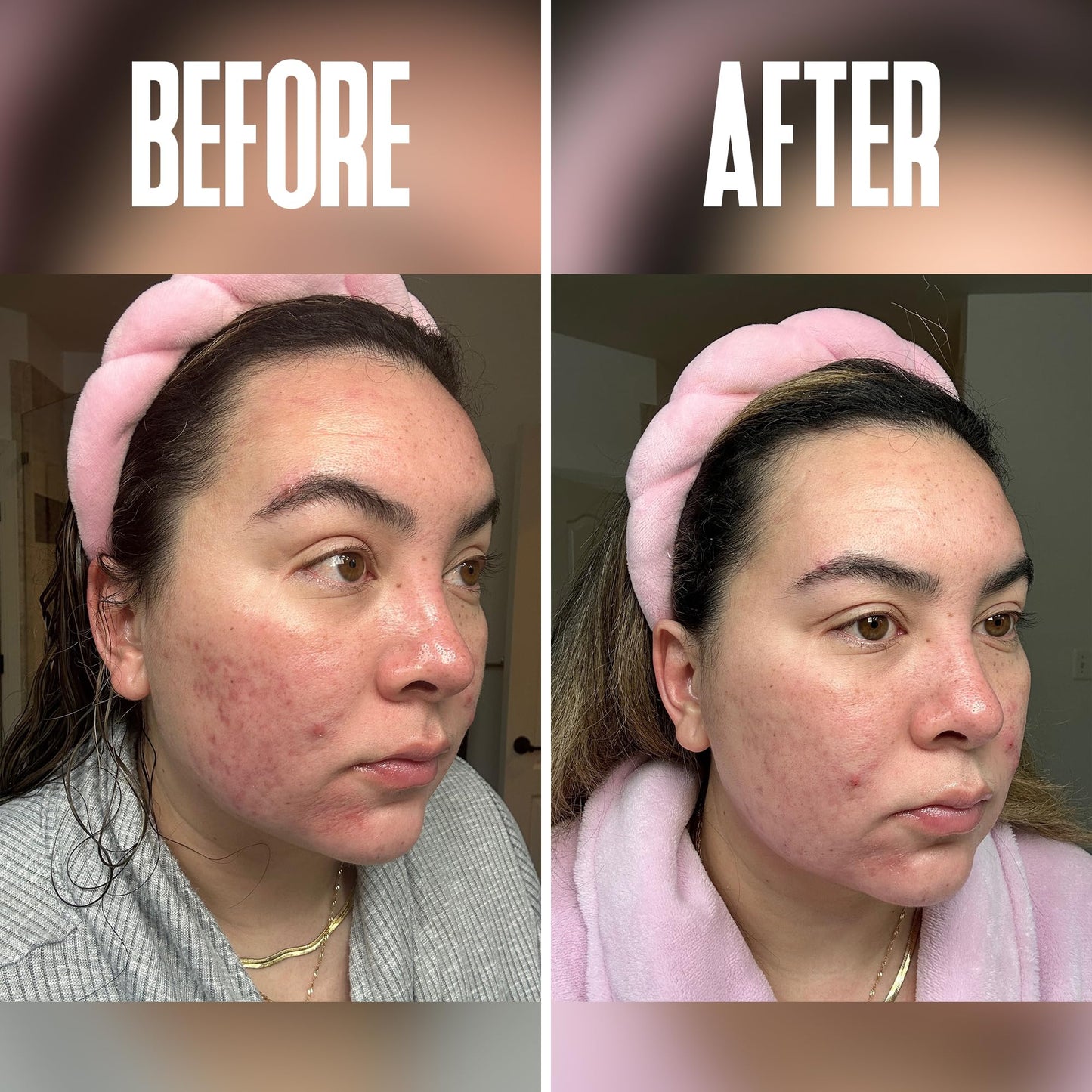 Anti Aging Skin Care Set: Glycolic Acid Peel 60% & Glycolic Resurfacing Pads - This Ultra Potent Duo Will Purify Your Skin & Eliminate Wrinkles, Acne Scarring For an Ultra Clear & Glowing Complexion