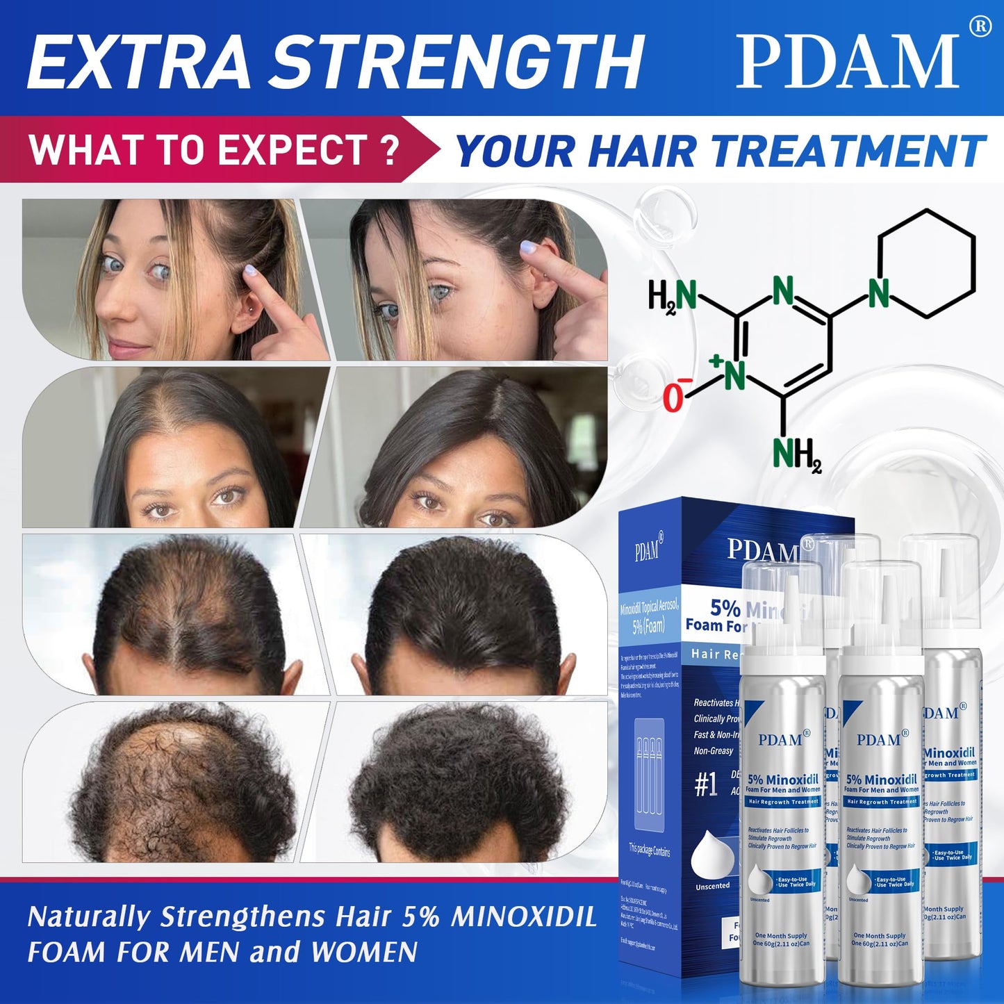 Minoxidil for Men and Women Foam Hair Growth - 5% Minoxidil Foam Hair Regrowth Treatment for Men, Topical Hair Loss Treatments, Extra Strength Thicker & Fuller Hair, 4 x 2.11 oz for 4 Months
