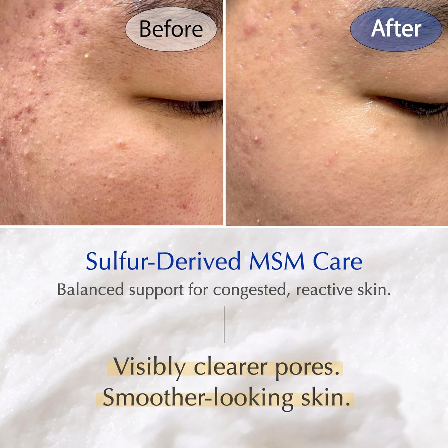 MSM Sulfur Deep Pore Cleanser | Low pH Face Wash for Sensitive Skin - Pore Reset Formula