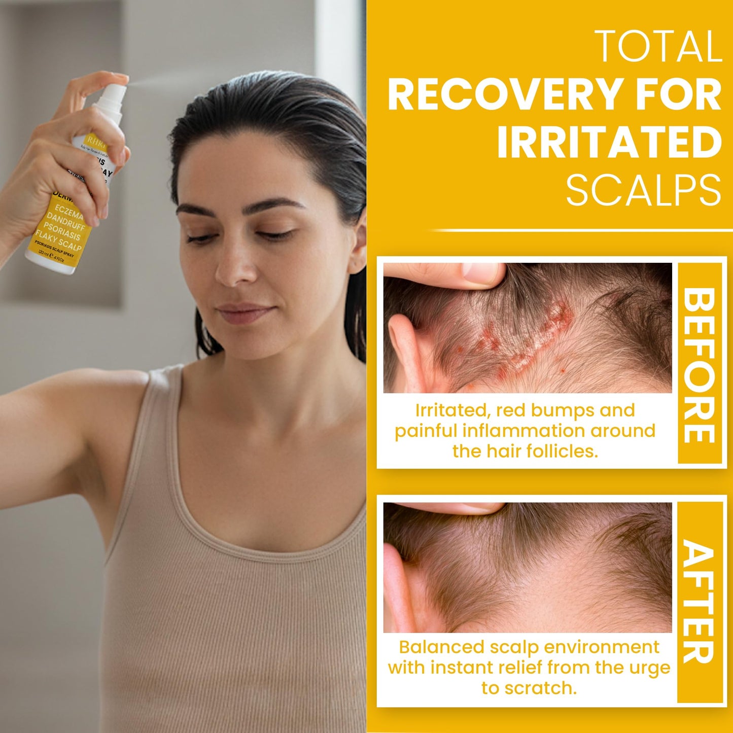 Psoriasis Scalp Spray | Psoriasis and Dandruff Treatment for Scalp Yeast Infections, Psoriasis Flare-Ups & Folliculitis | Antifungal Ringworm Itchy Scalp Spray for Dryness