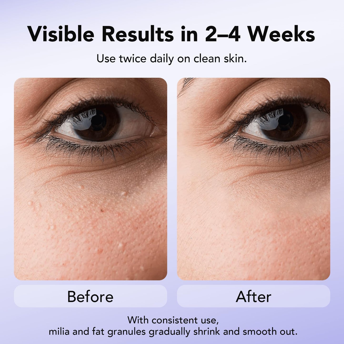 DERMFREE MILIA REMOVER 30 mL Milia Remover Treatment, Milia Spot Treatment with Salicylic Acid Milia Acne Serum Clearing Skin Essence