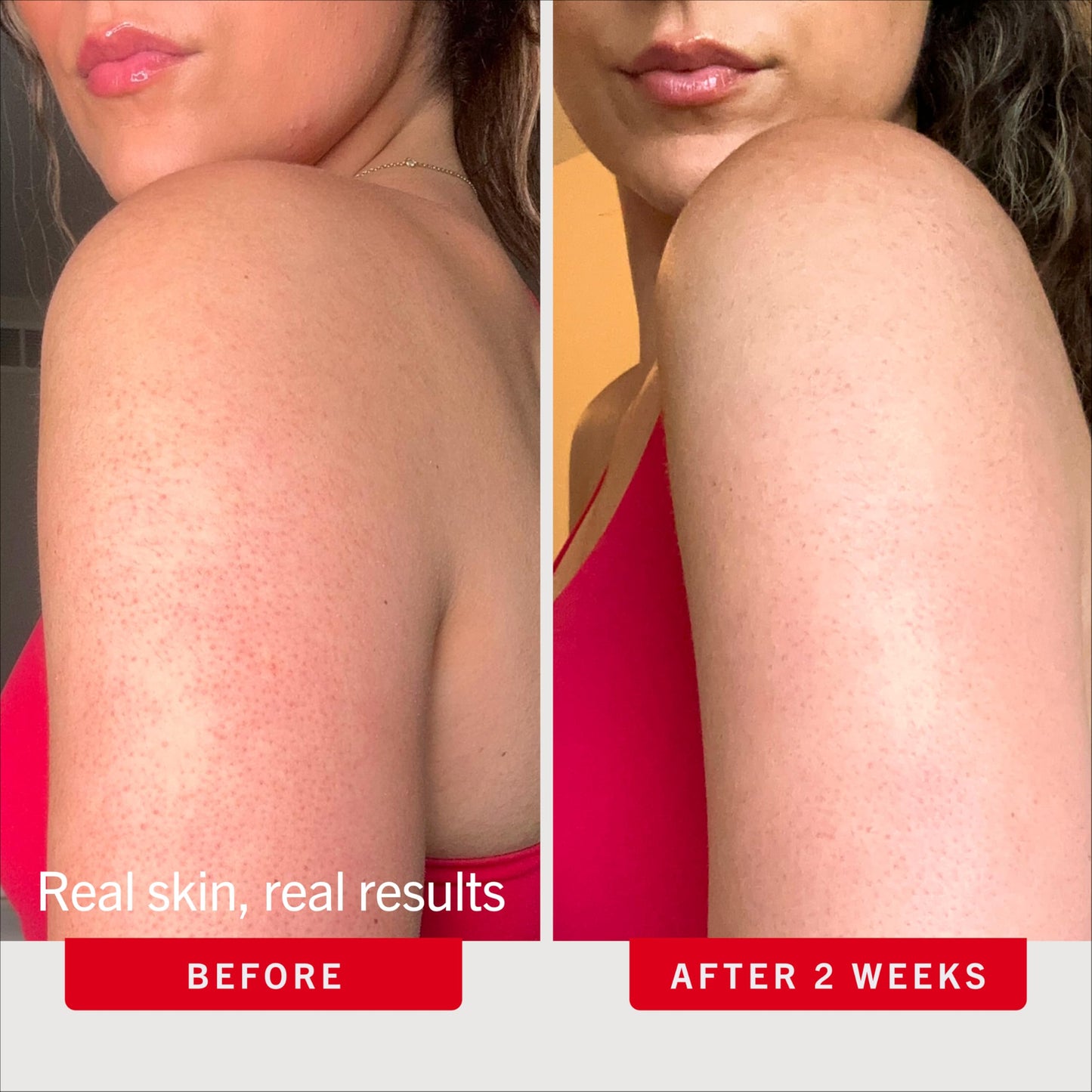 First Aid Beauty - KP Bump Eraser Body Scrub with 10% AHA, Keratosis Pilaris Skin Exfoliater with Glycolic and Lactic acids, Helps Reduce Chicken Skin Bumps, Safe for Sensitive Skin, 4 oz