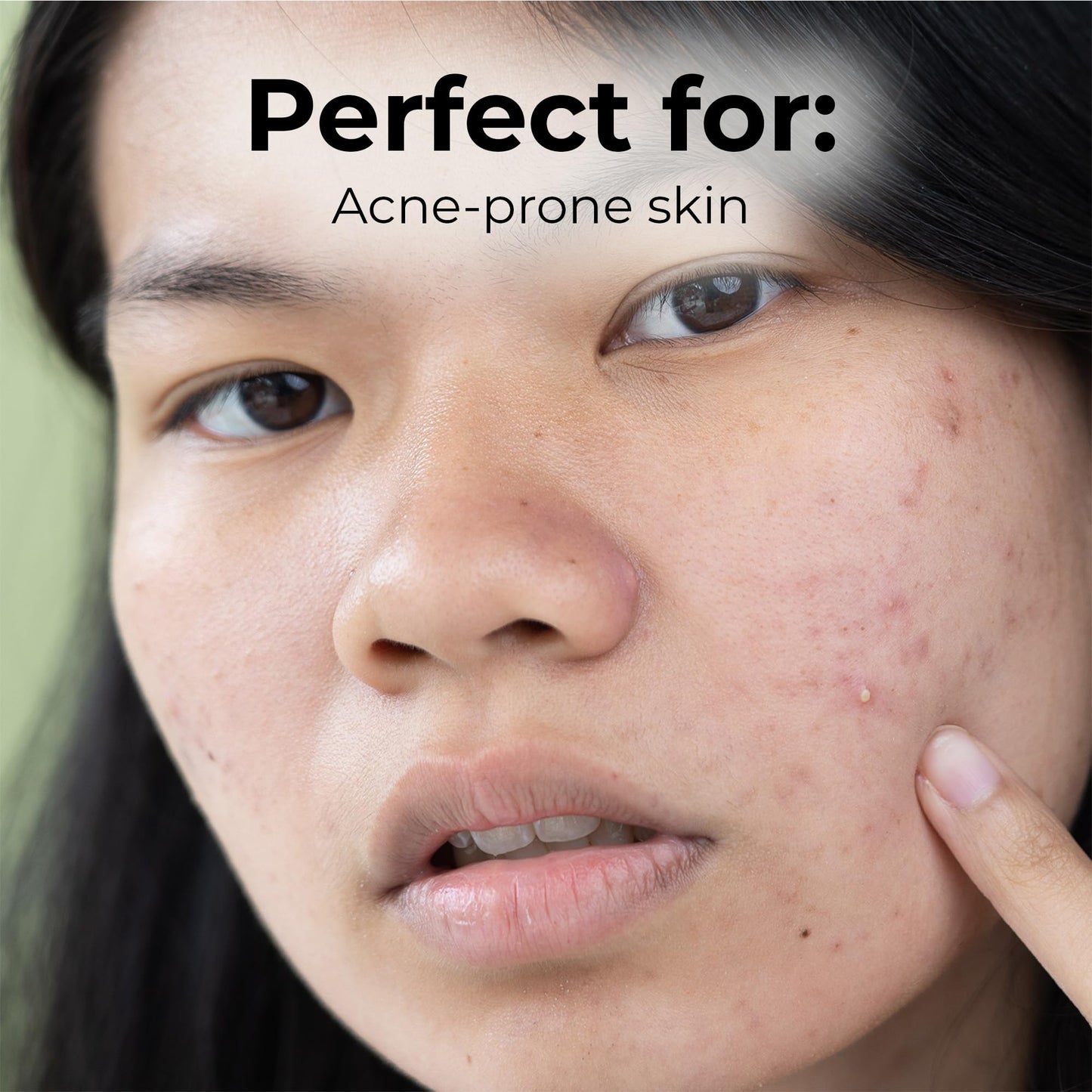Sonage Zitlox Salicylic Acne Gel: Spot Treatment with Tea Tree Oil | Clears Acne Blemishes | Benzoyl Peroxide Alternative