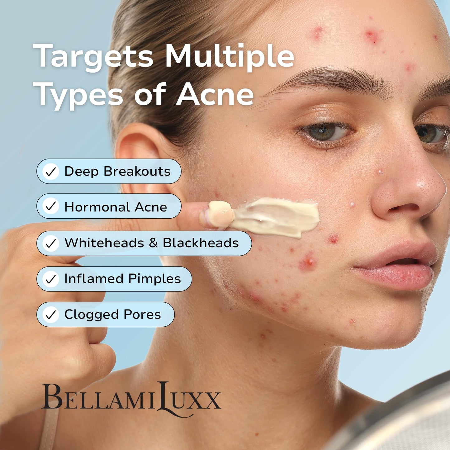 BellamiLuxx Cystic Acne Treatment for Face: Hormonal Acne Treatment Cream for Teens & Adults - Salicylic Acid & Tea Tree Oil Pimple Spot Remover - Anti-Acne Moisturizer Reduces Redness, Blemishes