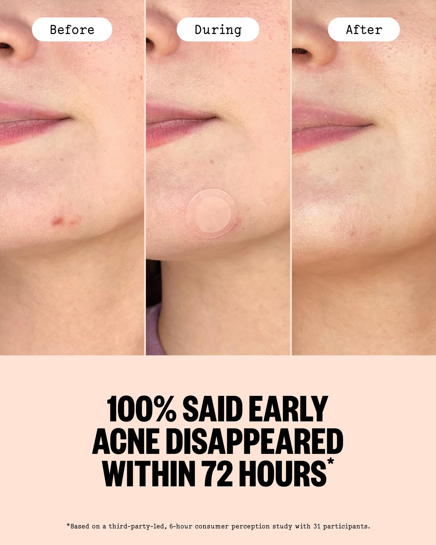 PEACE OUT Early Stage Acne Dots, Microneedling Acne Pimple Patches with 2% Salicylic Acid to Target Blemishes Forming Below the Surface (8 Count)