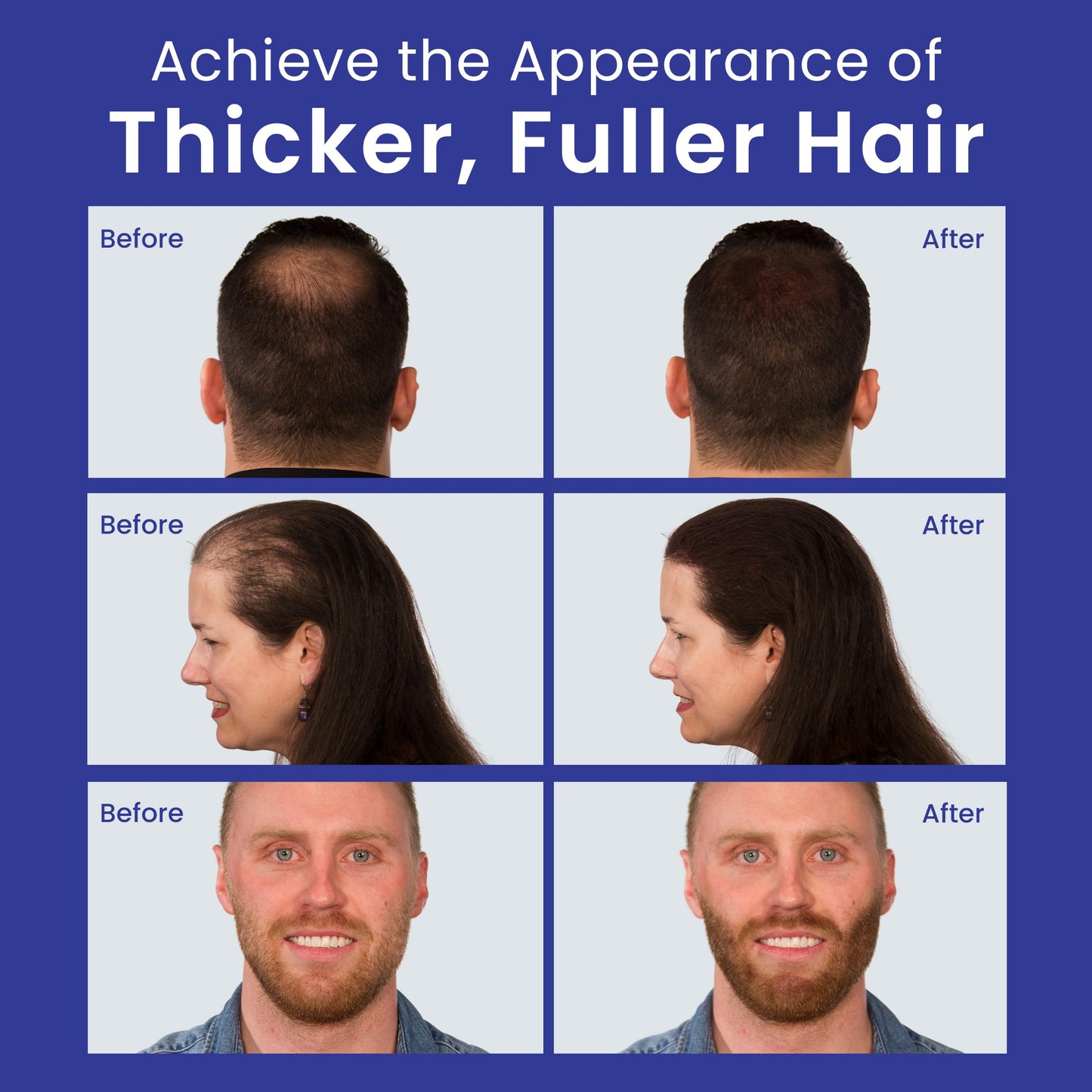 INFINITY Hair Fibers Dark Brown for Thinning Hair for Women & Men - 100% Undetectable Hair Building Fiber Powder - Conceal Hair Loss in 15 Seconds, 30g