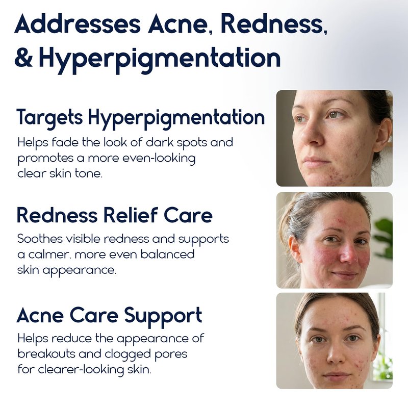 Pharmlitalia Azelaic Acid 15 Acne Cream for Face - Redness Relief, Rosacea Treatment for Face - Soothes Acne, Hyperpigmentation, Enhanced Formula for Brighter, Healthier Skin Care