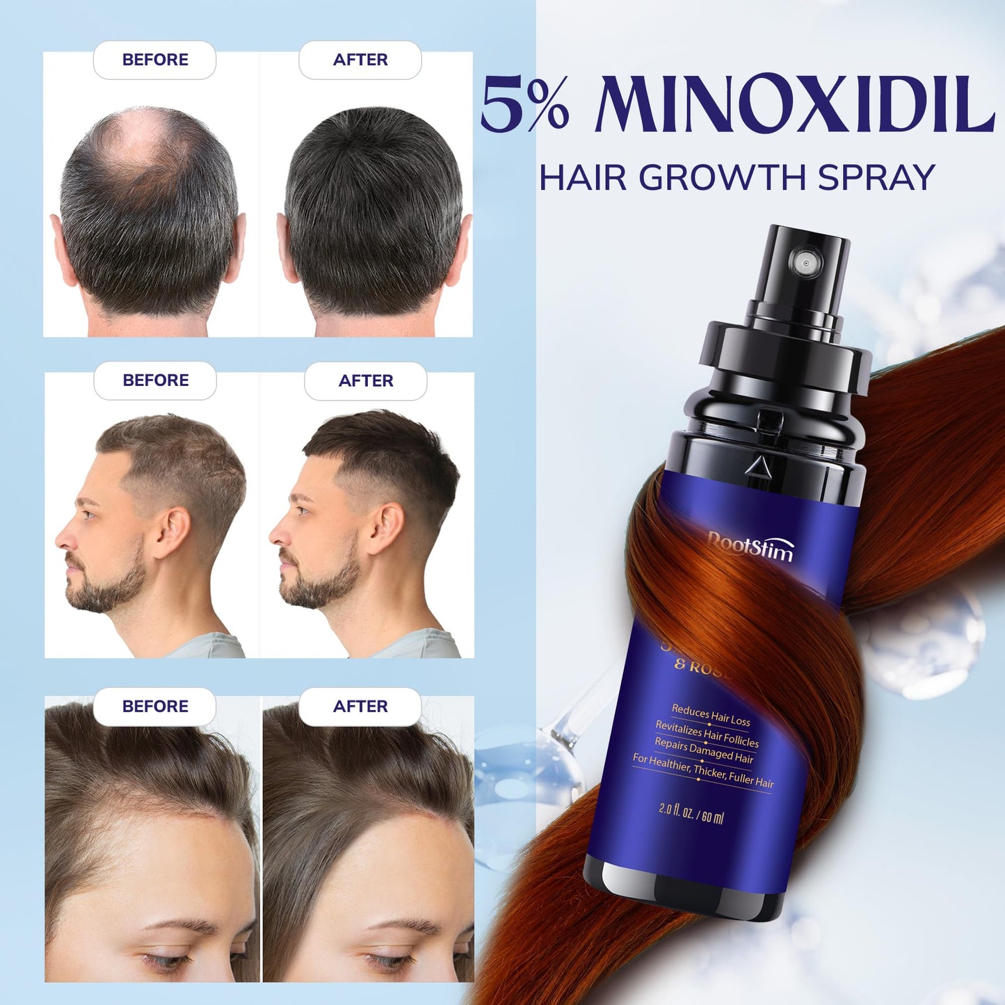 Minoxidil Hair Growth for Women Hair Loss Treatment