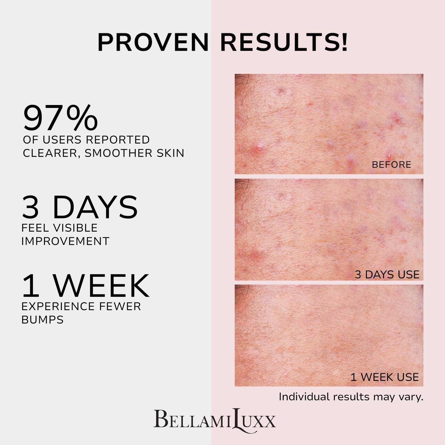 BellamiLuxx Butt Acne Clearing Treatment Lotion: 2% Salicylic Acid Body Acne Treatment for Breakouts on Buttocks & Thighs, Folliculitis, Bumps, Rough Texture - Tea Tree Oil Butt Cream for Smooth Skin