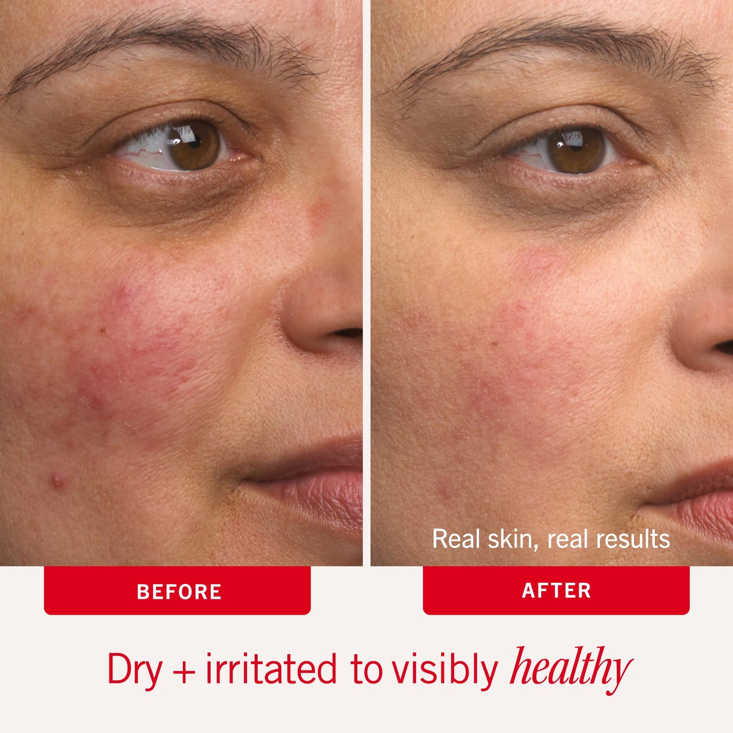 First Aid Beauty - Ultra Repair Cream - Intense Hydration Face & Body Moisturizer - Whipped Colloidal Oatmeal Clinically Proven to Strengthen Skin Barrier in 7 Days - Helps Relieve Eczema, 6 oz