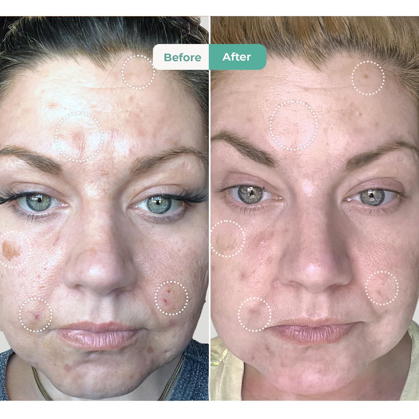 Sonage Zitlox Salicylic Acne Gel: Spot Treatment with Tea Tree Oil | Clears Acne Blemishes | Benzoyl Peroxide Alternative