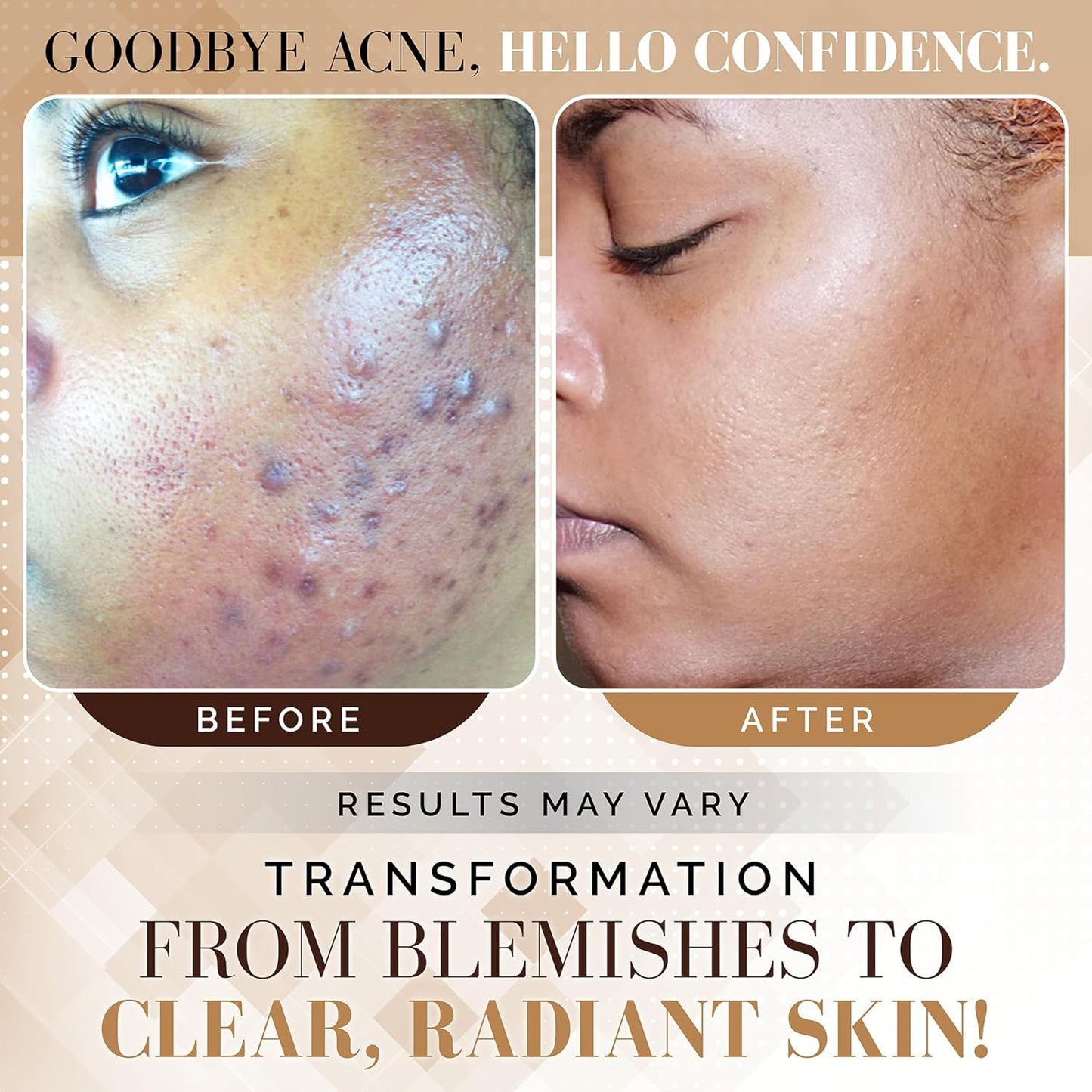Acne Scar Treatment - Three Step Hyperpigmentation Repair Set | Normal to Oily Skin, Dark Spot Remover