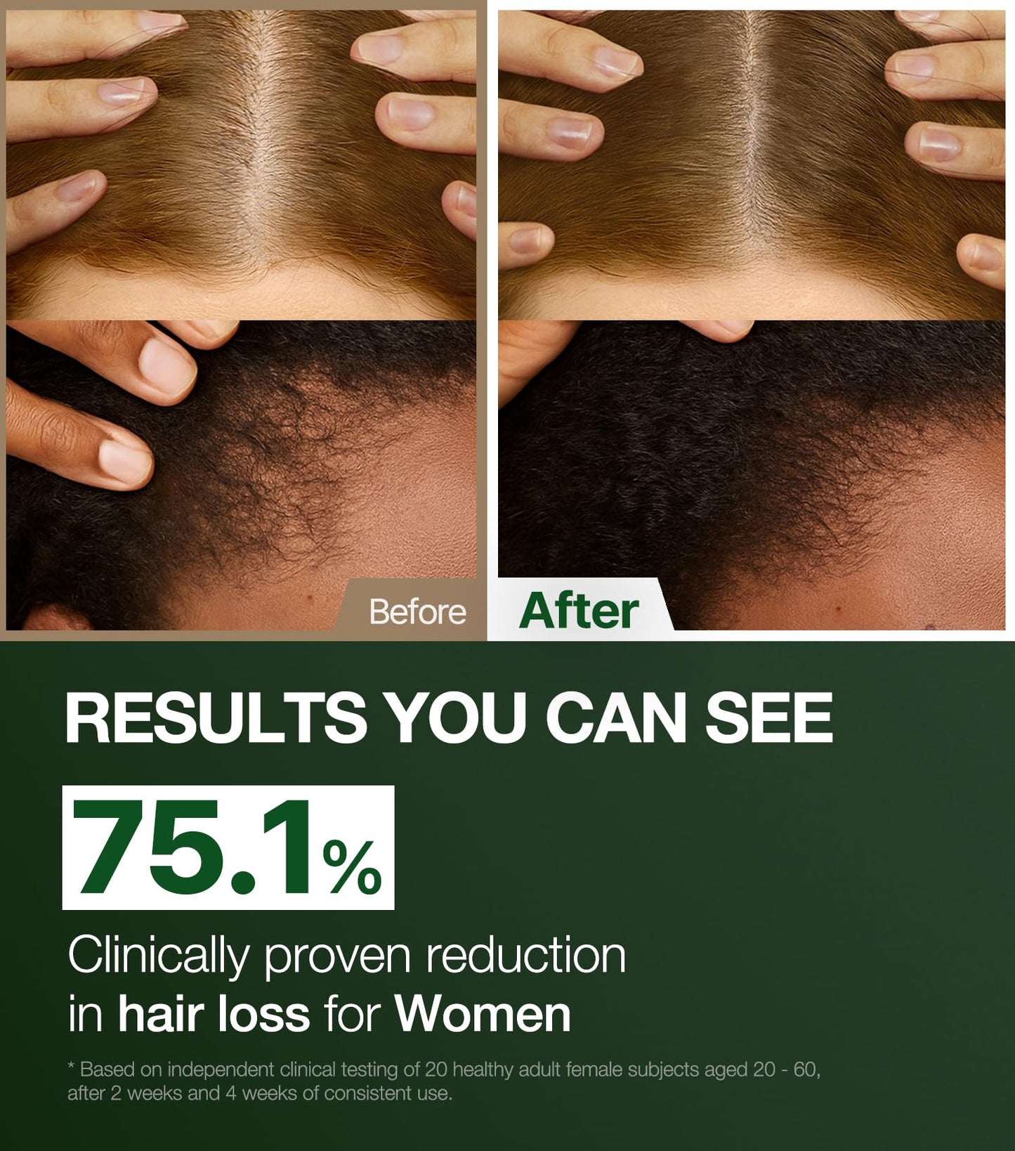 ROOTON Alpha Erguen Hair Loss Shampoo for Women, Vegan Scalp Care Shampoo for Thinning Hair, Weak Hair & Hair Shedding, Pregnancy Safe Formula & Postpartum Hair Care, 500ml / 16.9 fl oz
