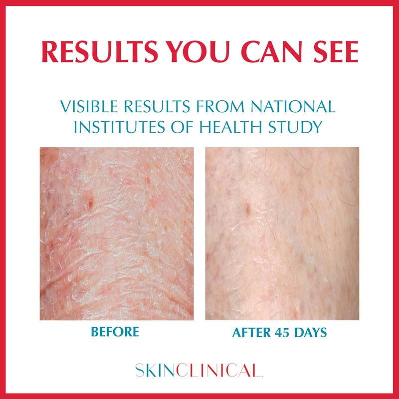 SkinClinical Daily Restore Hydrating and Moisturizing Body Lotion For Very Dry Skin, Psoriasis and Eczema Aftercare, Nourishes Skin with SBD-4 Patented Ingredient, Unscented Body and Face Lotion, 6 oz