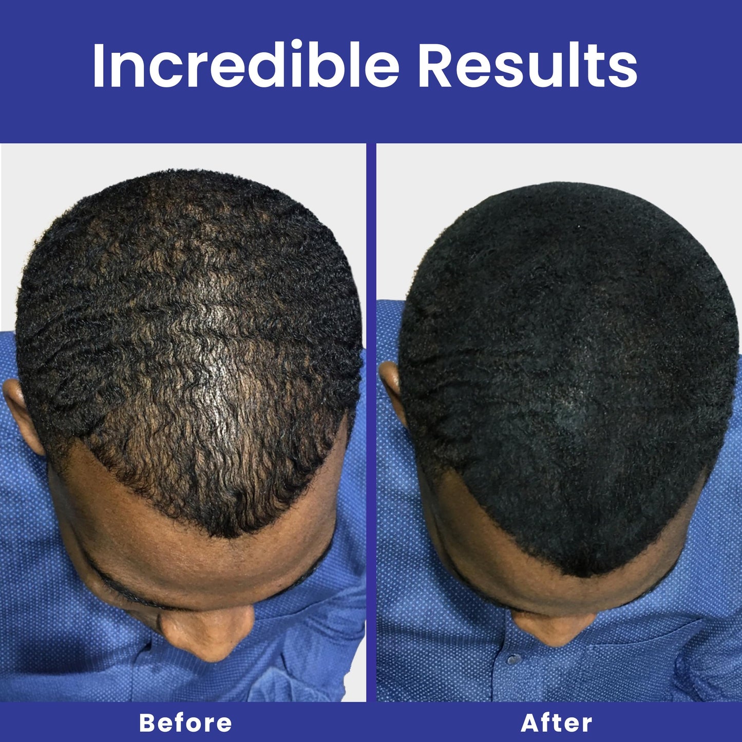 INFINITY Hair Fibers Dark Brown for Thinning Hair for Women & Men - 100% Undetectable Hair Building Fiber Powder - Conceal Hair Loss in 15 Seconds, 30g