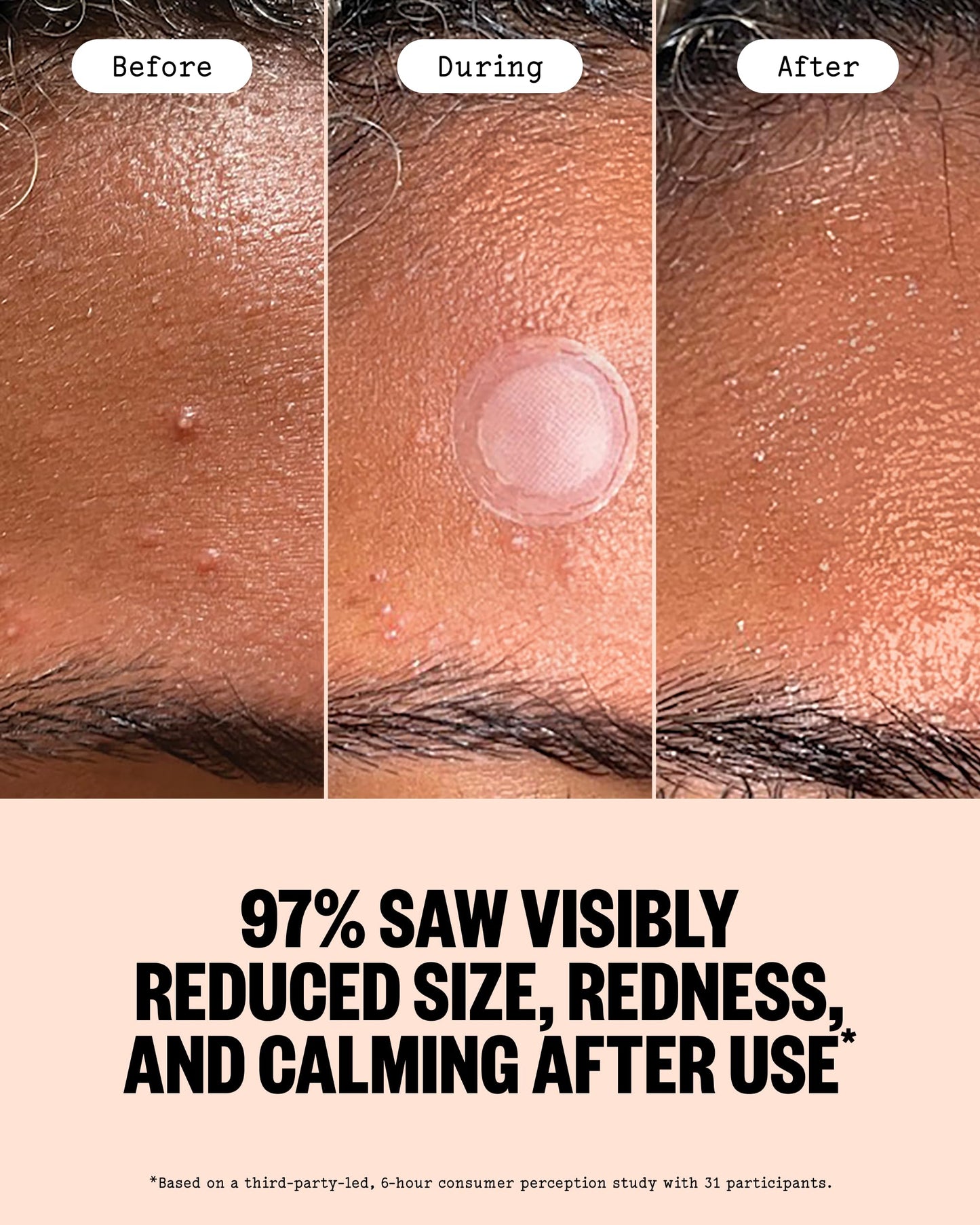 PEACE OUT Early Stage Acne Dots, Microneedling Acne Pimple Patches with 2% Salicylic Acid to Target Blemishes Forming Below the Surface (8 Count)