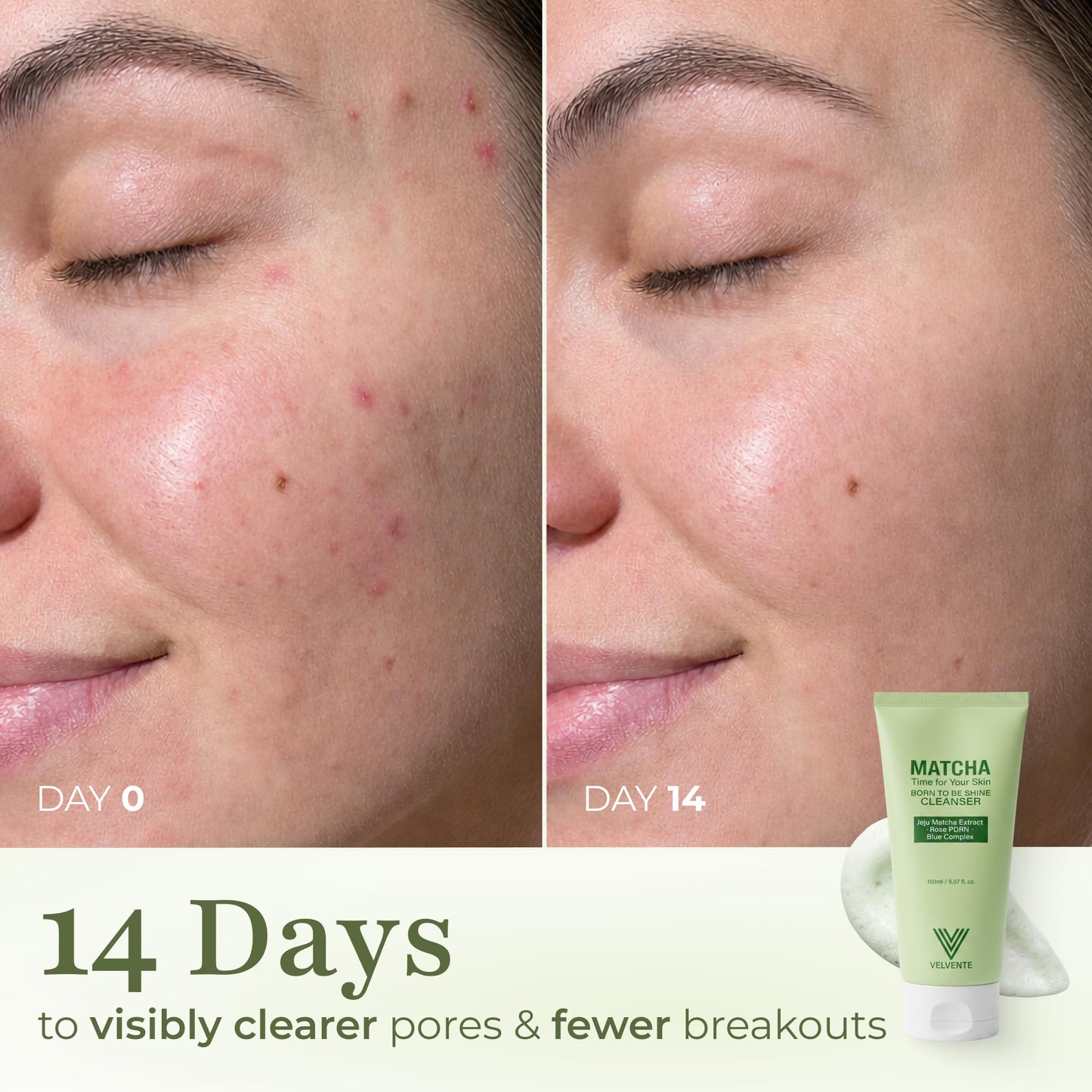 VELVENTE Matcha PDRN Korean Cleanser & Face Wash, Acne-Prone Sensitive Skin