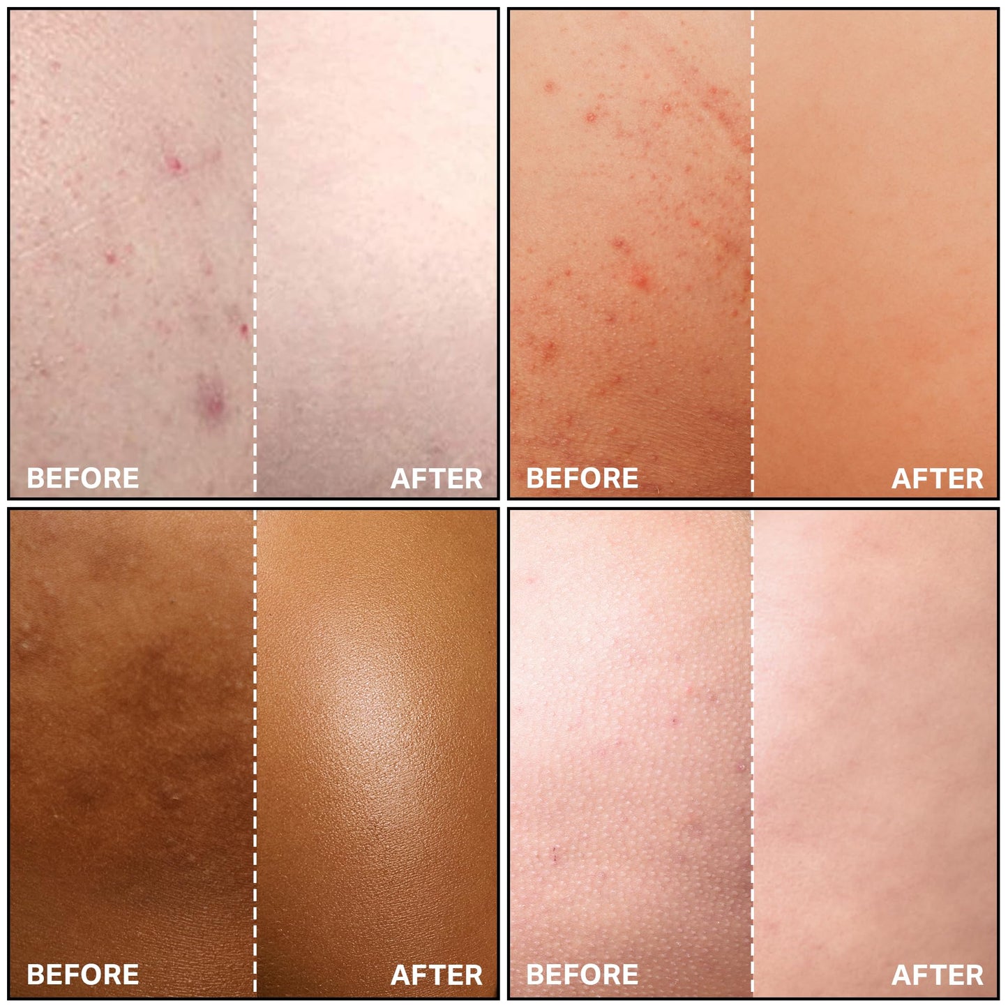 SKINBOSS 5oz Butt Acne Clearing Treatment - Body Acne Lotion for Pimples on Buttocks, Thighs, & Body, Targets Folliculitis, Scars, & Dark Spots, Hydrating Anti-Blemish Body & Self-Care Butt Cream