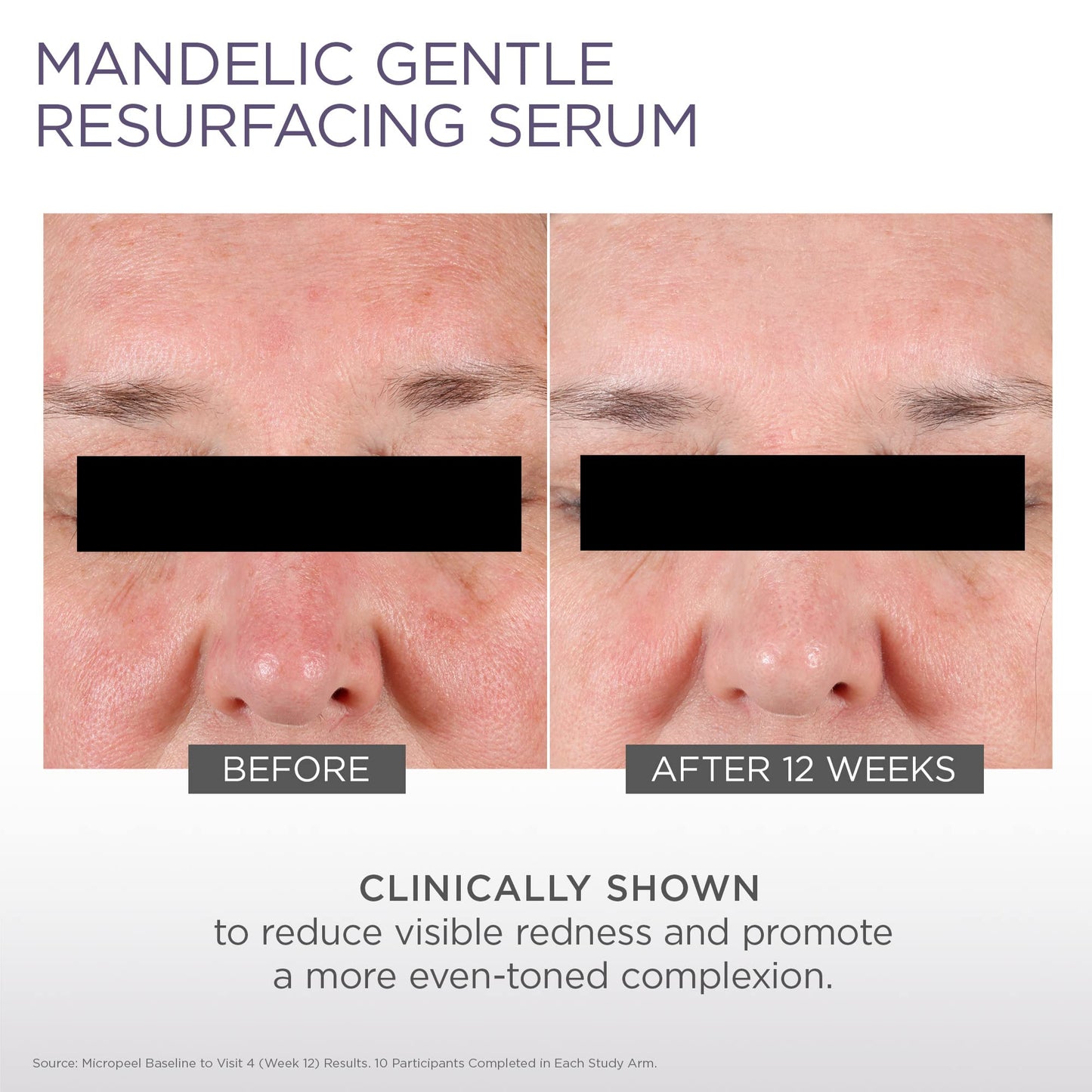 Glytone Micro-Peel 10% Mandelic Acid Serum | Anti-Aging AHA Gentle Exfoliant with Phytic Acid for all Skin types | Reduces Redness, Uneven tone & Dark Spots | Fragrance-Free, Paraben-Free - 1 Fl oz.