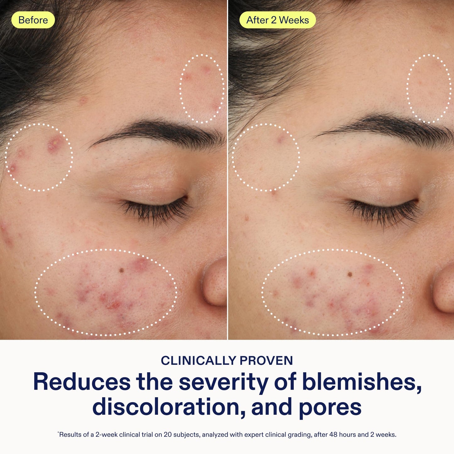 Skinfix 2% BHA Cleanser - 5 oz - Clears Acne Blemishes & Blackheads - Safe for All Types of Acne - Fragrance Free - Vegan, Cruelty Free