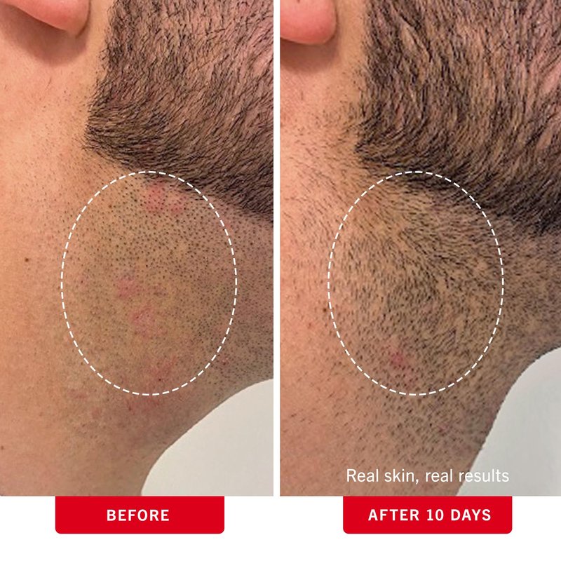 First Aid Beauty - Ingrown Hair Pads with BHA + AHA - Aftershave Treatment Pads to Help Prevent Razor Bumps for Men & Women - Exfoliate Underarms & Bikini Area - Compostable for Daily Use - 28 Pads