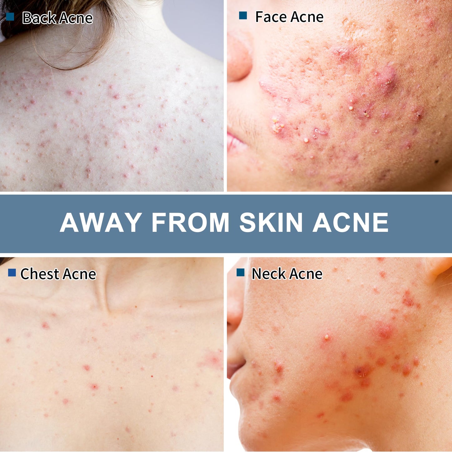 Natouch Acne Wipes for Face & Back, Acne Treatment Wipes with Salicylic Acid, Acne Scars and Dark Spot Remover with Natural Essential Oil for Face, Body, Back, and Butt