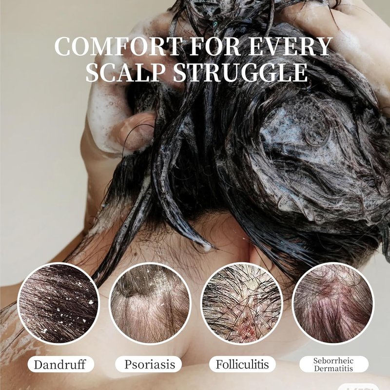 Dandruff Shampoo - Anti-Fungal Scalp Treatment for Psoriasis & Dermatitis | Itching Relief, 300ML (Peppermint)
