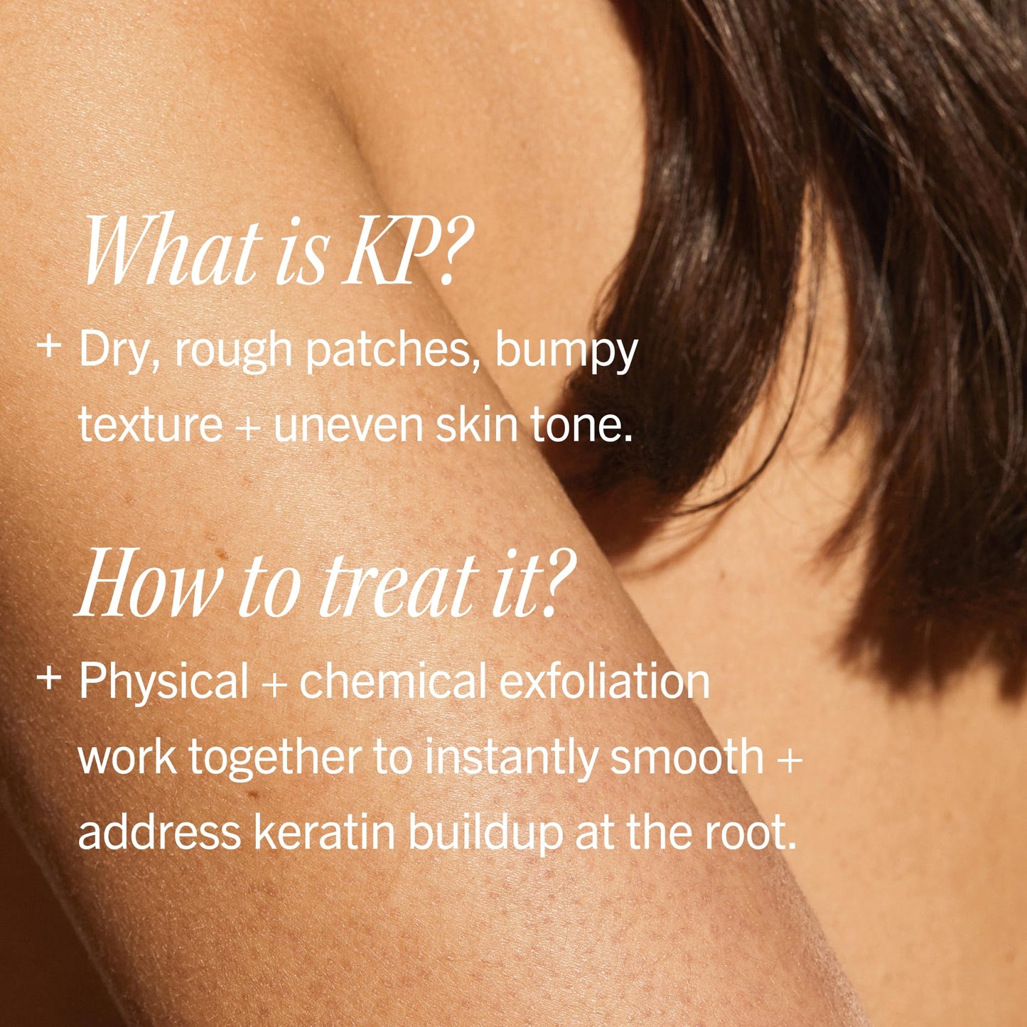 First Aid Beauty - KP Bump Eraser Body Scrub with 10% AHA, Keratosis Pilaris Skin Exfoliater with Glycolic and Lactic acids, Helps Reduce Chicken Skin Bumps, Safe for Sensitive Skin, 4 oz