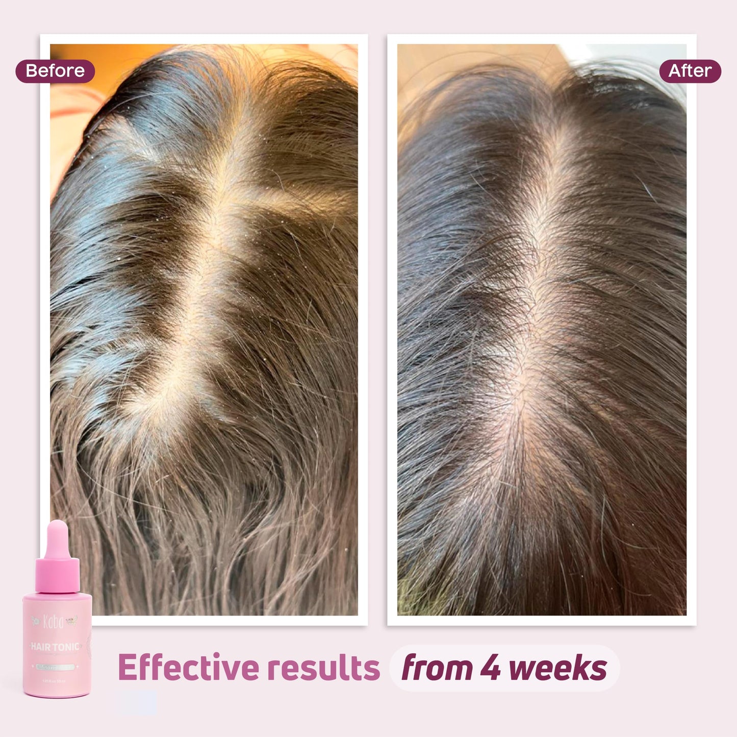 Kaba Tonic Hair Growth Serum - Hair Growth Products, Hair Loss Treatments for Women, Growth Accelerator, Regrowth Treatment, Control Excessive Oil - 1 Oz