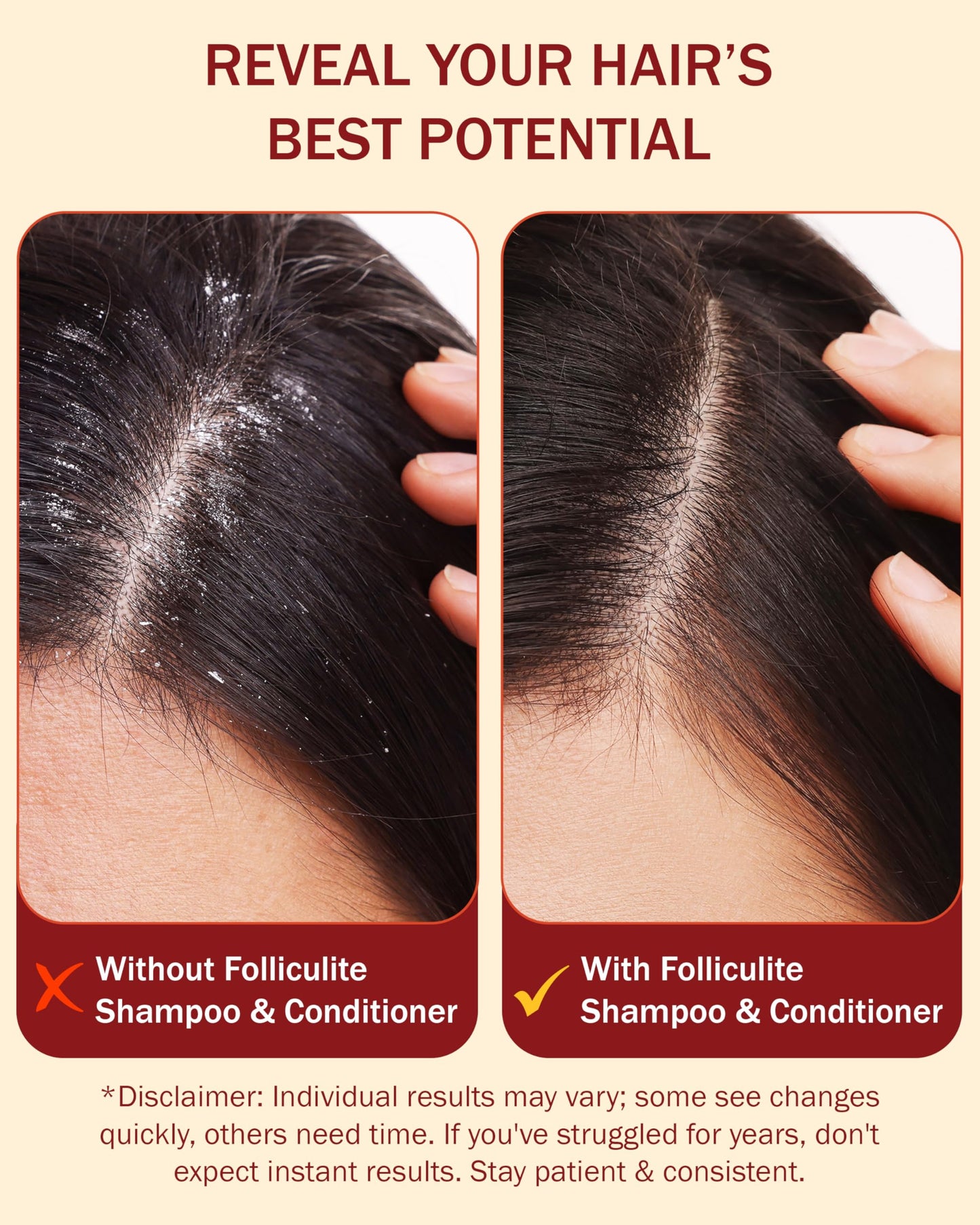 Folliculitis Treatment Shampoo and Conditioner with 3% BHA, Salicylic Acid, Aloe Vera & Tea Tree Oil - Anti Itch Shampoo for women & men with Flaky Scalp Treatment Acne, Made in USA by e70, 8 fl oz