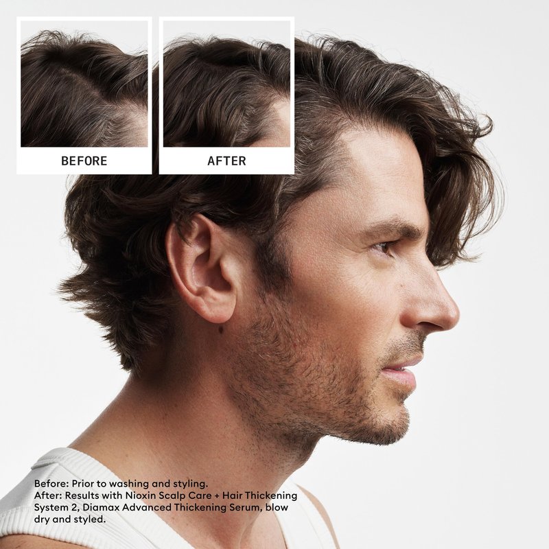 Nioxin Scalp + Hair Thickening System 2 Shampoo| For Natural or Untreated Hair with Progressed Thinning| With Niacinamide and Biotin| 33.8 Fl oz.