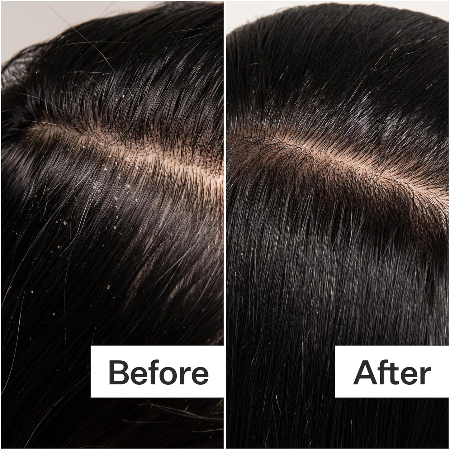 ACT+ ACRE Scalp Detox Oil - Cold Processed, Sulfate-Free Treatment for Flaky, Dry Scalp | Promotes Thicker Hair