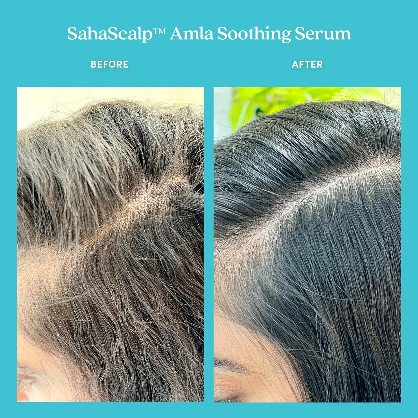 Amla Soothing Serum - Purifying Rosemary Oil Treatment for Dry, Itchy Scalps | Detox & Balance Irritation